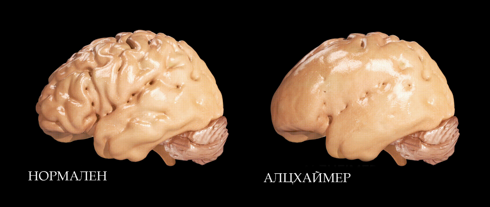 normal-and-alzheimer-brain