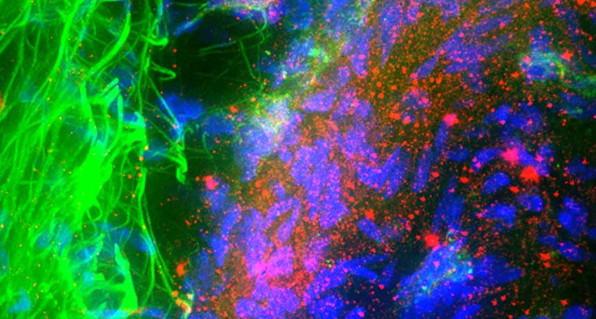 Алфа-синуклеинът (червено) се натрупва в нервните клетки (синьо) при болестта на Паркинсон. Credit: Roger J. Bick & Mya C. Schiess/UT-Houston Medical School/Science Source