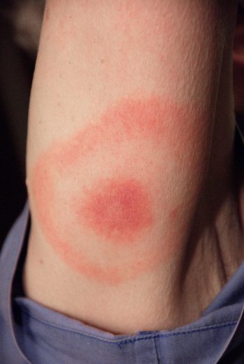 Класическа проява на erythema migrans върху кожата на човек. В центъра на обрива е мястото на ухапването.