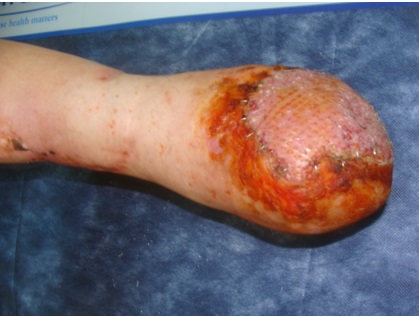 Симултантно лечение при гилотинна ампутация на долен крайник в комбинация със свободна кожна автотрансплантация