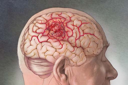 glioblastoma_pharmastar.it_.jpg