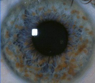 Очни прояви при неврофиброматоза